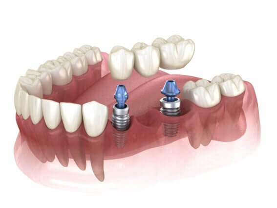 Zahnbrücke unterstützt durch Implantate