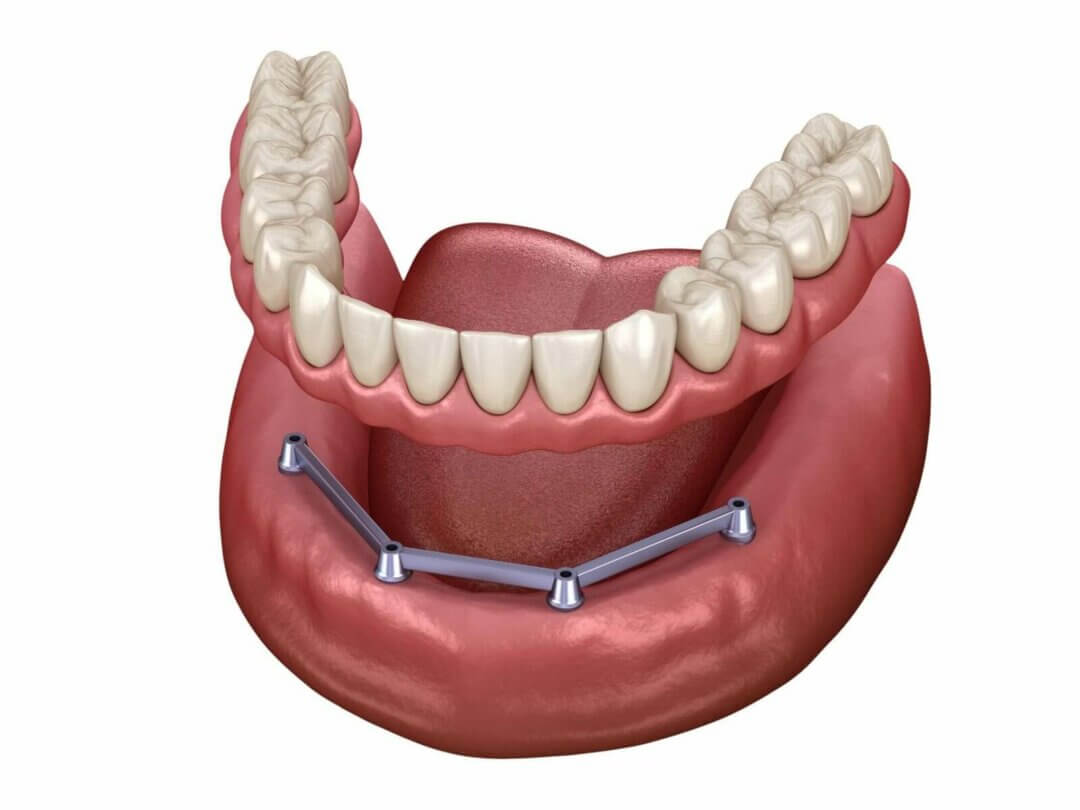 Herausnehmbarer Zahnersatz / Gaumenfreie Prothese