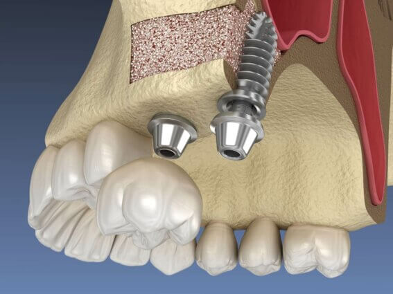 Sinus Lift Chirurgie - Implantatinstallation