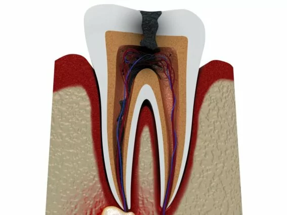 Entzündeter Zahnnerv mit einer zu entfernenden Zyste