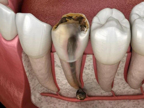 Nicht erhaltungsfähiger, zerstörter Zahn