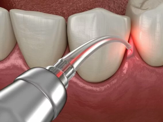Laserbehandlung einer Zahnfleischerkrankung